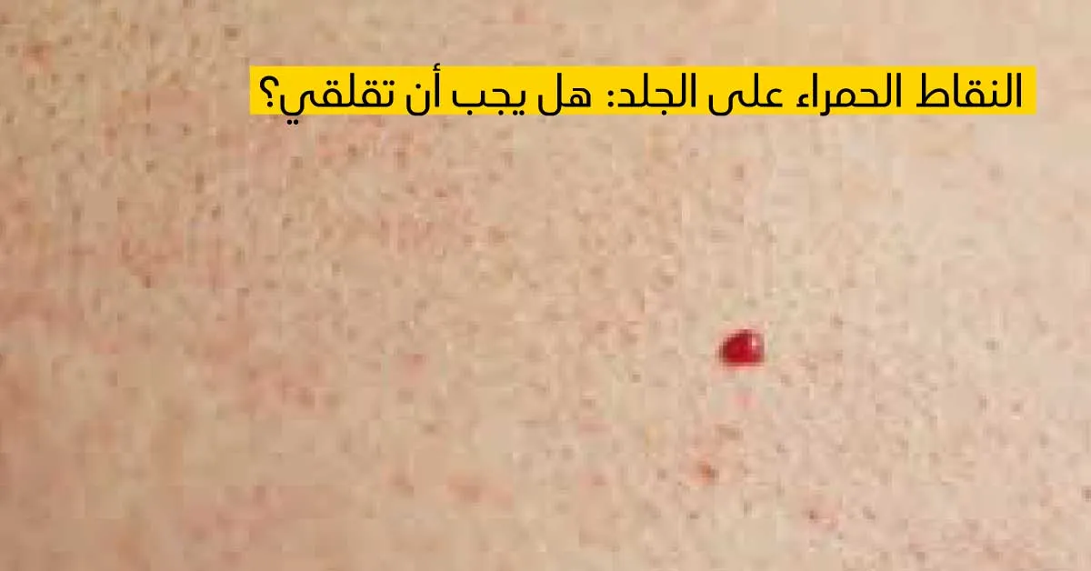 النقاط الحمراء على الجلد: هل يجب أن تقلقي؟